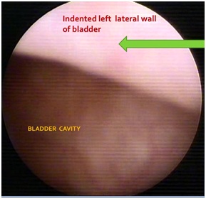Surgical Management Paravesical Paraganglioma Using a Robotic Platform