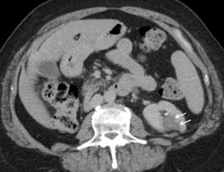 Percutaneous Treatment of a Urinary Leak with Fibrin Glue During A Radiofrequency Ablation of a Renal Tumor