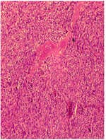 An Interesting Unusual Case of Giant Retroperitoneal Mass