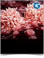 Stabilization of Disease Progression in a Case of Duchenne Muscular Dystrophy with Cellular Transplantation