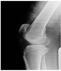 Atraumatic Avulsion of the Patellar Tendon to the Tibial Tuberosity in An Adult Without Predisposing Factors: A Case Report