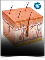 Phototherapy-Induced Erythema in a Patient with Psoriasis and Obesity Treated with Narrowband UVB Phototherapy