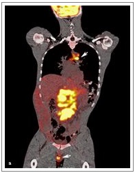 Imprint Cytology as a Valuable Tool in the Diagnosis of Metastatic Embryonal Carcinoma
