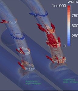 Arteriotomy for AV Fistula, Cut it Right!
