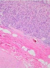 Incidence of Gastrointestinal Stromal Tumors Is Drastically Increased In Patients with Morbid Obesity