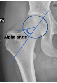 Prevalence of Abnormal Hip Alpha Angle in Football Players- A Potential Contributory Factor to Other Pathologies