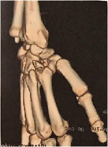 A Rare Case of Trapezoid Fracture