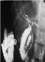 Intraparenchymal Stenting in Blunt Liver Trauma: A Case Report of a Simultaneous Damage-Control and Tissue-Sparing Surgical Technique