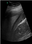 Emergency Presentation of Spleen Associated Complication After Laparoscopic Sleeve Gastrectomy