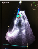 Aortic Sutureless Bioprosthesis Distortion by Suction of Aortic Vent