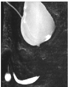 Magnetic Resonance Imaging (MRI) in Pelvic Fracture Urethral Injuries to Evaluate Urethral Gap: A Protocol Based Study