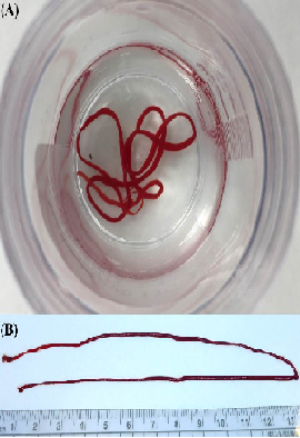 A Stringy-like Blood Clot Mimicking Parasite in the Urinary Bladder