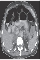 Primary Adrenal Insufficiency due to Bilateral Adrenal Hemorrhage in a Patient with Antiphospholipid Syndrome