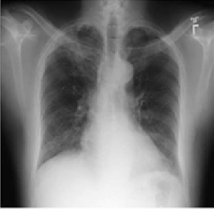 Diffuse Alveolar Hemorrhage Due to Synthetic Cannabinoid Inhalation
