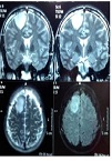 Neuroanesthesia in an Awake Patient in A University Hospital in Latin America