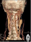 A Report of Right Carotid Artery Pseudoaneurysm with Pulmonary Artery Aneurysm