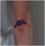 Elbow Plasty