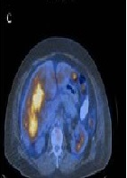 Detection of Hepatic Metastases by 18F-FDG PET/CT and MRI