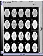 Performance Characteristics of Spect Imaging System in Clinical Environment