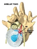 Selective Endoscopic Lumbar Discectomy (SED™) and Thermal Annuloplasty for Discogenic Back Pain, Disc Herniations and Sciatica in High Performance Athletes and Physically Active Patients