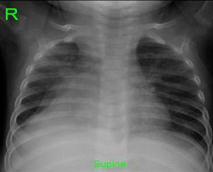 Tuberculosis Presenting With a Mediastinal Mass in an Infant
