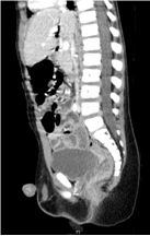 Penetrating Rectal Trauma: Laparoscopic Management without Fecal Diversion