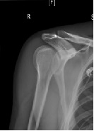 Case Report: Minimally Invasive Open Reduction and Internal Fixation of a Humeral Head-Splitting Fracture-Dislocation in A Young Man