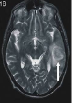 A Case of Unusual Presentation of Transverse and Sigmoid Sinus Thrombosis in Puerperium