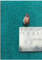 Management of a Dentigerous Cyst Associated with Mesiodens: A Case Report