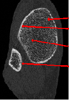 Novel Imaging Modalities in The Diagnosis and Risk Stratification of Osteoporosis