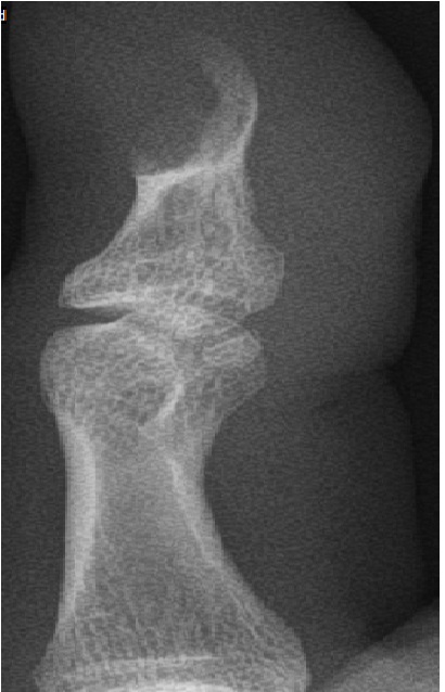 An Innovation in the Management of Osteolytic Lesions in Distal Phalanges of Digits