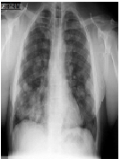 Disseminated Cutaneous Malignancy - A Very Rare Presentation