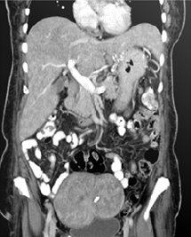 Intra-Abdominal Sarcoidosis In 54-Year-Old Indian Lady A Case Report
