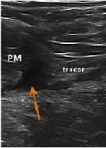 Case Report: Platelet Rich Plasma Injection Used as Treatment of High-Grade Partial Pectoralis Muscle Tear in Division I Football Player