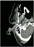 Severe Aural Myiasis in Emergency Room