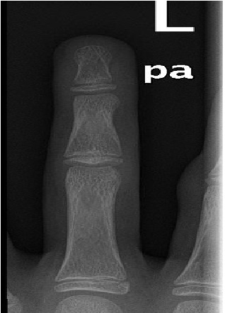 The Rise of Hoverboard Related Finger Injuries