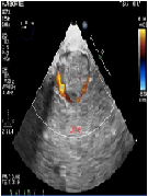 Use of Transesophageal Echocardiography During Cesarean Section in A Parturient with Inferior Vena Cava Thrombosis:A Case Report