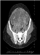 An Extraordinary Cause of Krukenberg Tumor in Immuncompetent Adult Woman