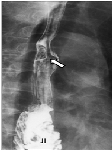Successful Esophagectomy and Colon Interposition for Metachronous Esophageal Cancer in A Patient with A History of Total Gastrectomy and Jejunal Interposition