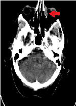 Unusual Presantatıon of Extranodal Non-Hodgkın Lymphoma: Isolated Nasolacrımal Mantle Cell Lymphoma