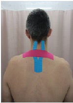 The Potential Effect of Cervical Taping on Pain, Disability and Kinematics in Patients with Chronic Neck Pain - A Quasi-Experimental Study