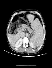 Industrial Solvents: Underlying Potential Risks of Left-Sided Potal Hypertension Associated with Positive JAK2-V617F Gene