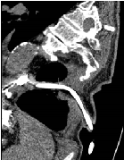 Controlled Esophagocutaneous Fistula with a T-Tube Drainage, as a Method of Control of Late Diagnosed Perforation of Acute Oesophageal Ulcer