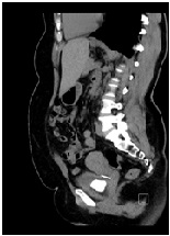 Migratory Foreign Body in The Urinary Bladder-An Unusual Cause of Vesical Calculus