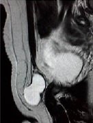 Hydrocele of Canal of Nuck - A Rare Entity
