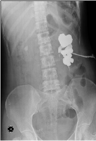 An Old Rarely Used, And Efficient Method: Ureterocalicostomy: Case Report