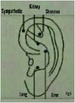 Current Acupuncture Research on Opiate Drug Addiction