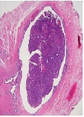 Mammary-Like Gland Adenoma of The Vulva in An Adolescent: A Case Report