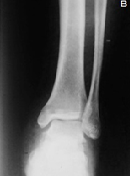 Post Traumatic Anterior Sub-talarDislocation