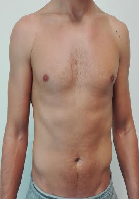 Pectoralis Major Tendon Rupture in a Rugby Player-Clinical Case